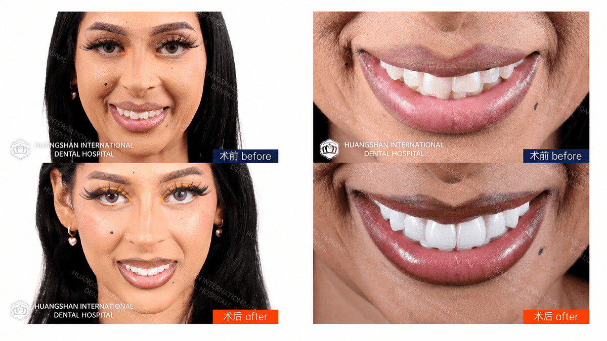 Veneer Before and After: Real Smile Transformation Guide