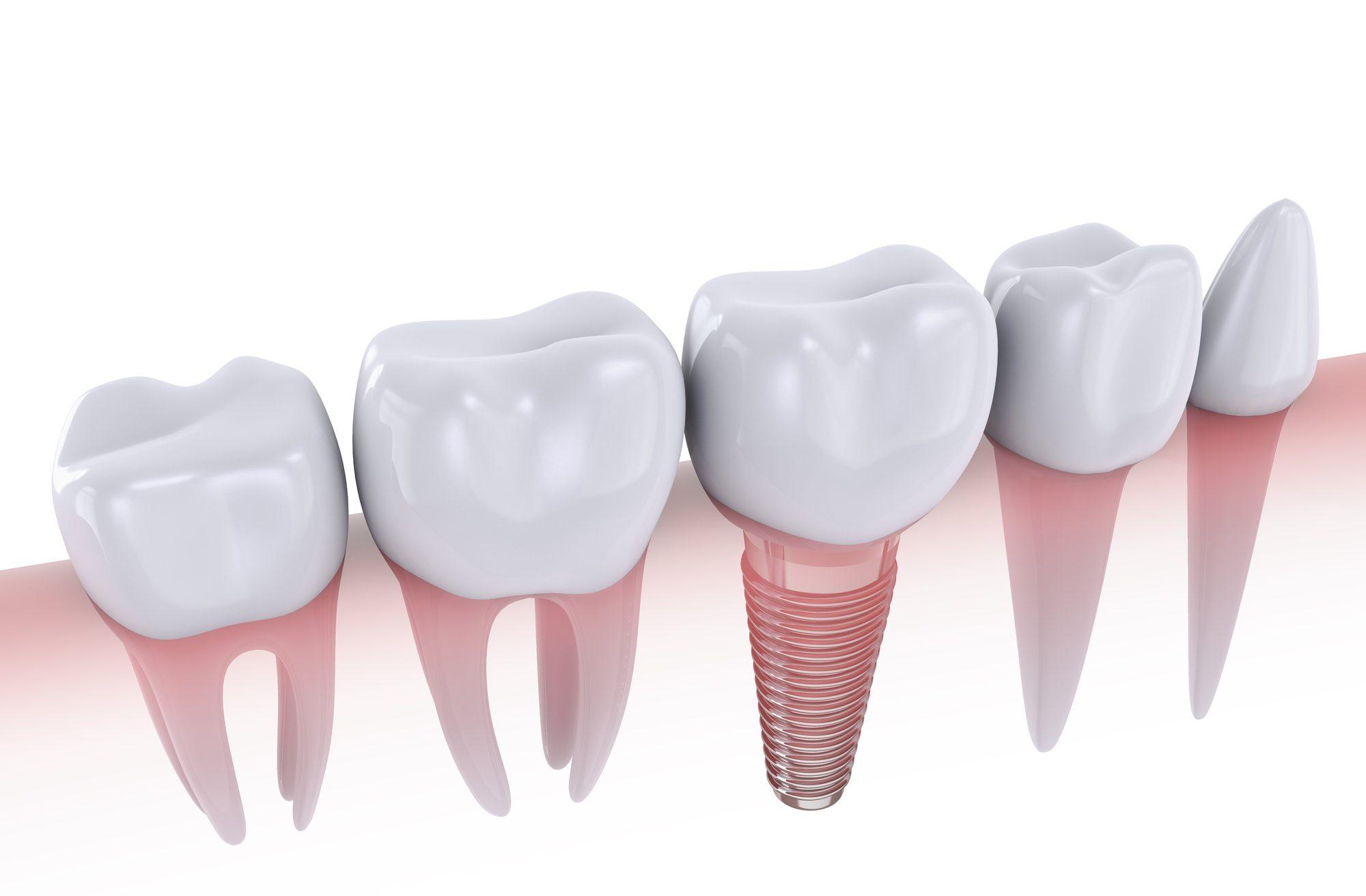 DENTAL IMPLANTS