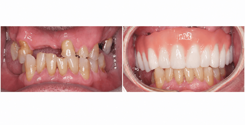 Upper Jaw All-on-6 Dental Implants for Missing Teeth
