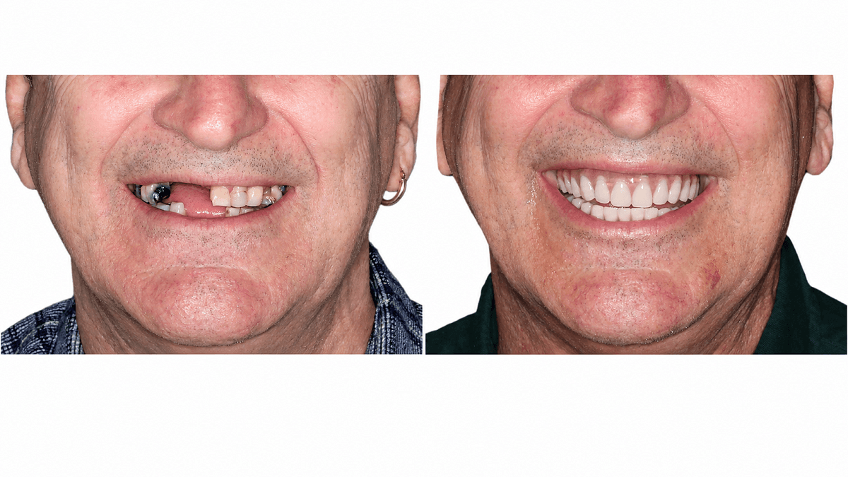 All-on-6 Dental Implant Case After 5 Years Missing Teeth