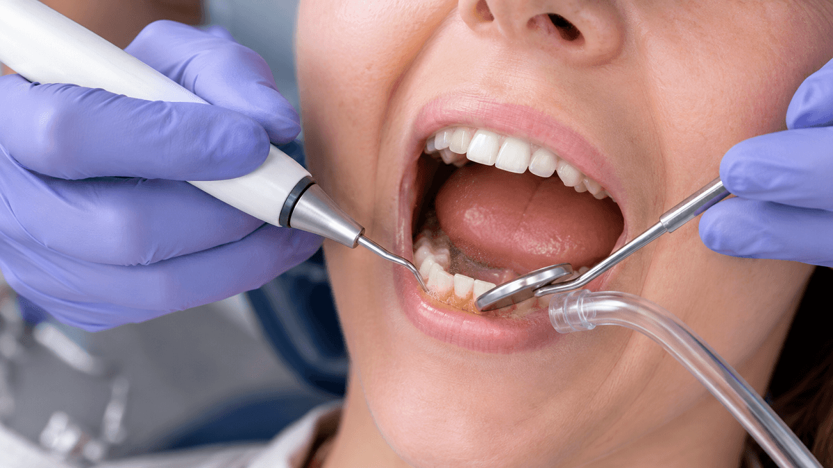 Tartar on Teeth: Causes, Removal, Cost 2026 Guide