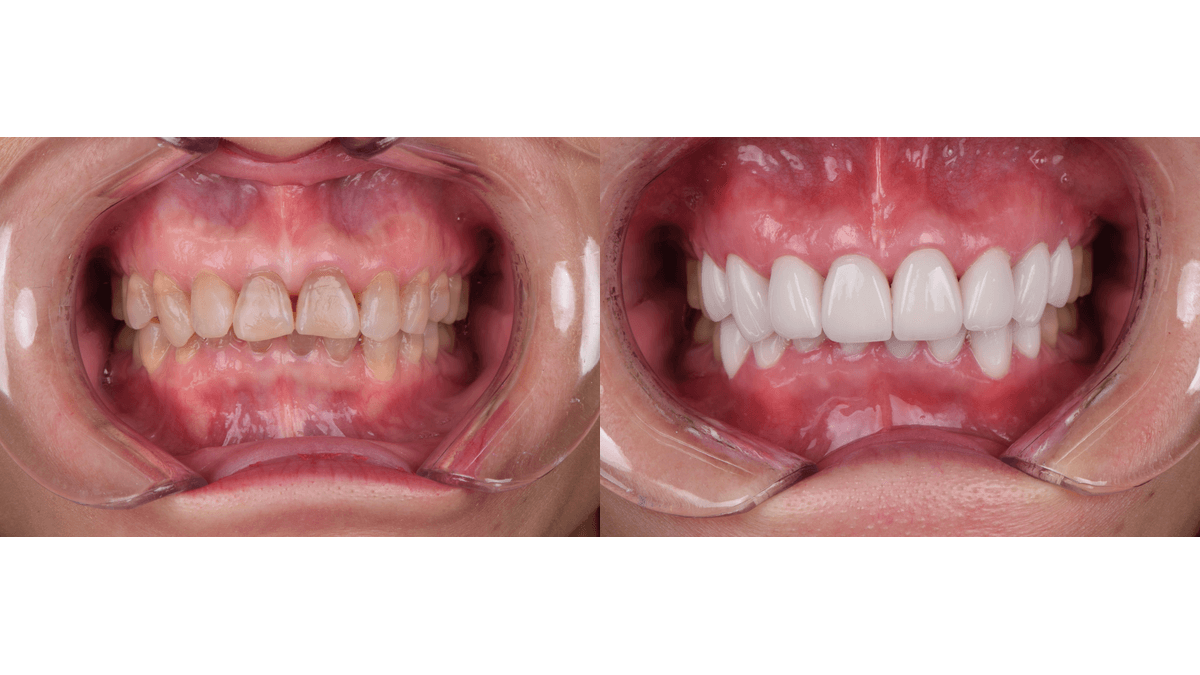 Porcelain Veneers for Tetracycline Stains in Huangshan Dental