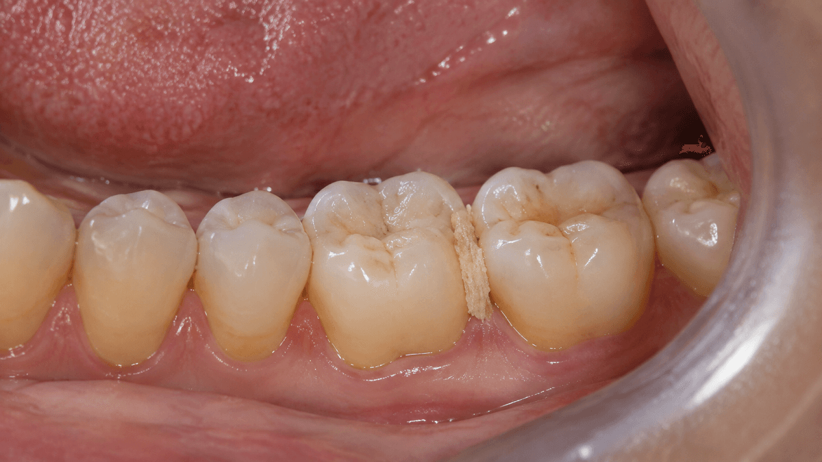 Food Impaction in Teeth: Causes and Fixes