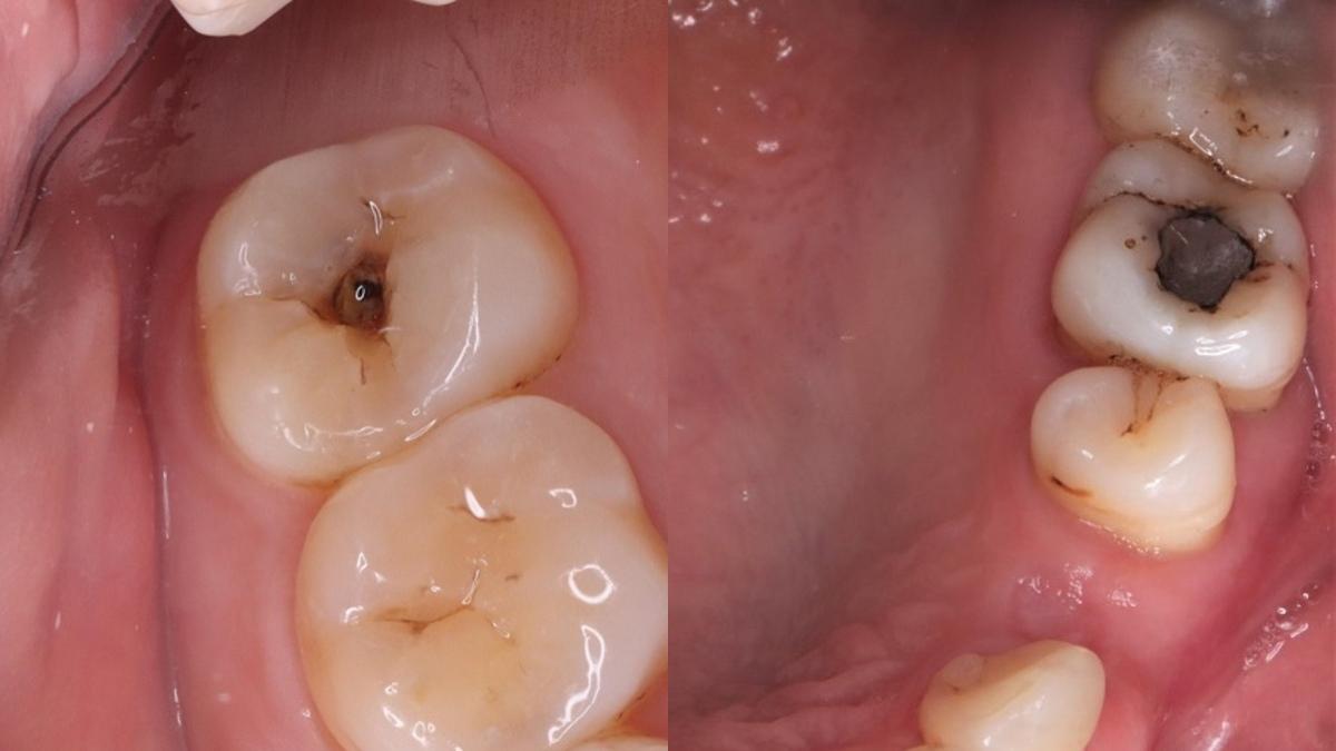What does a cavity look like? Signs & Treatment (2026)