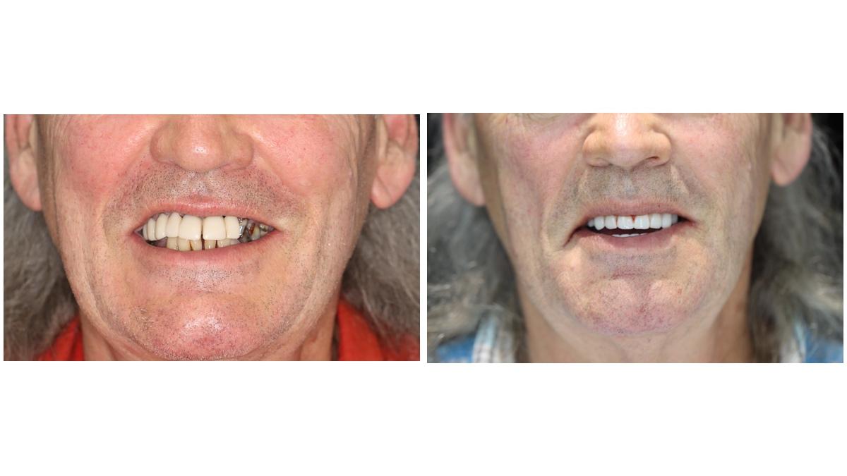 Dental Implants for Diabetics: Case and Review in 2026