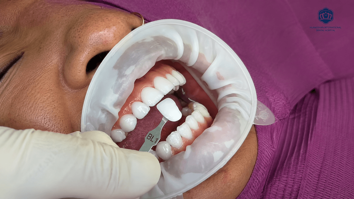 Are Dental Veneers Right for You? Cost, Risks, and Benefits