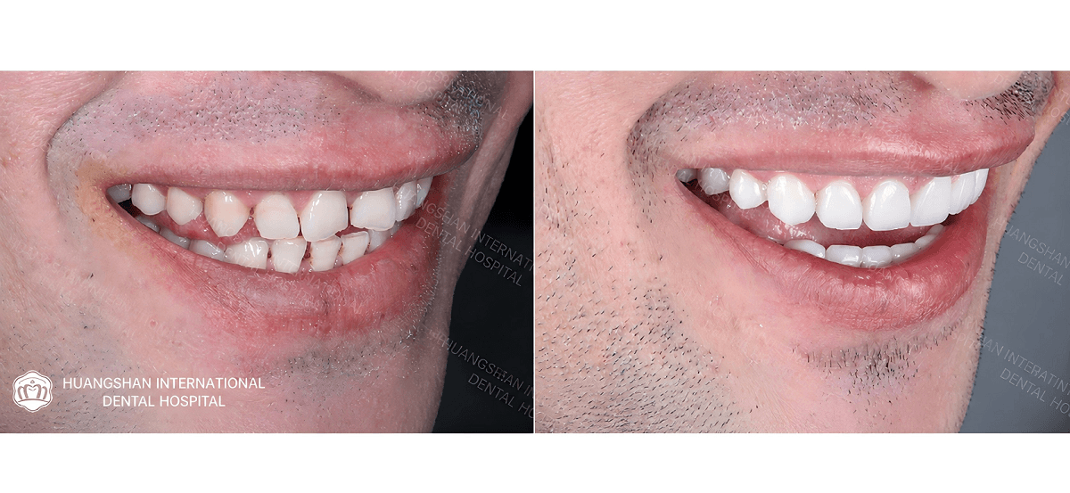 Veneer for Teeth Gap vs Braces: Which Is Better?