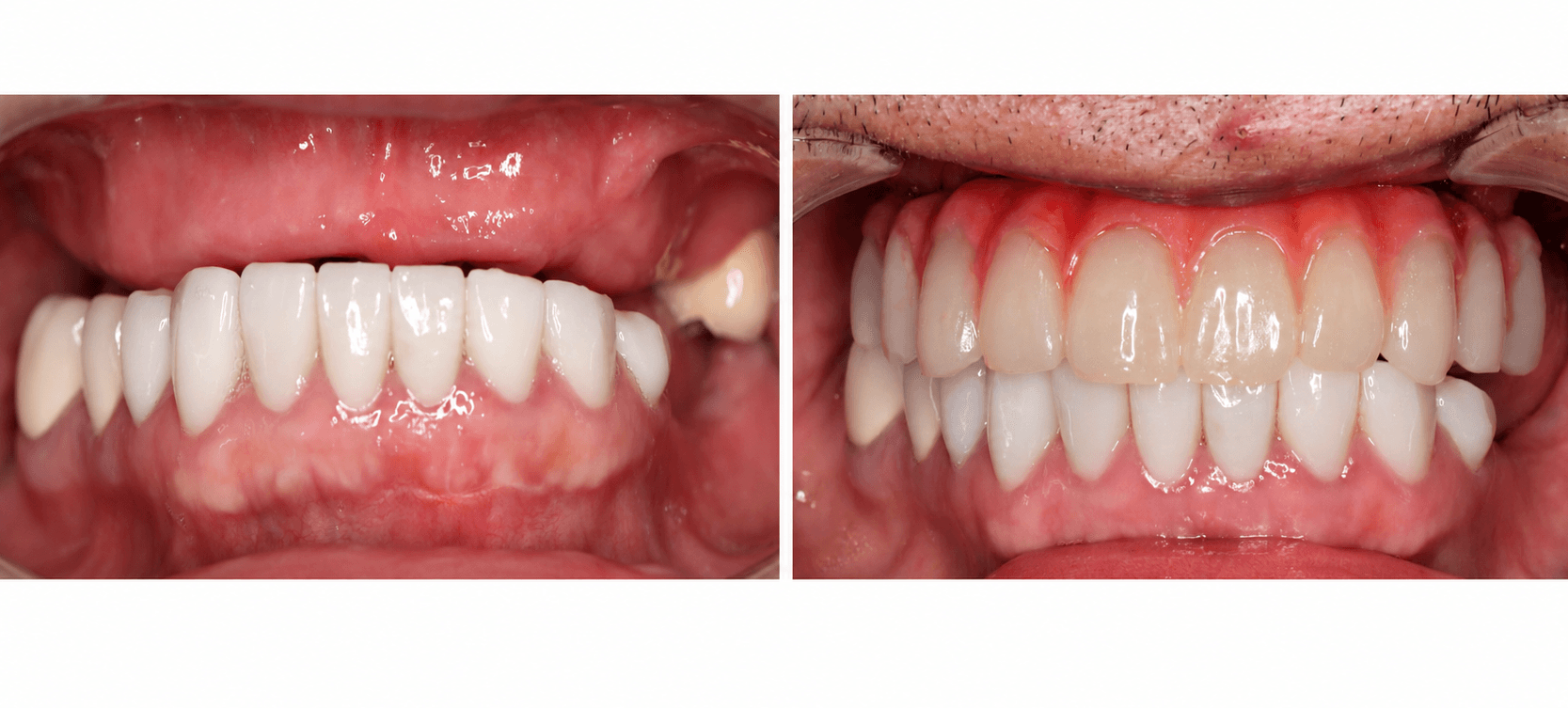 Failed Dental Implant: Can It Be Replaced Successfully?