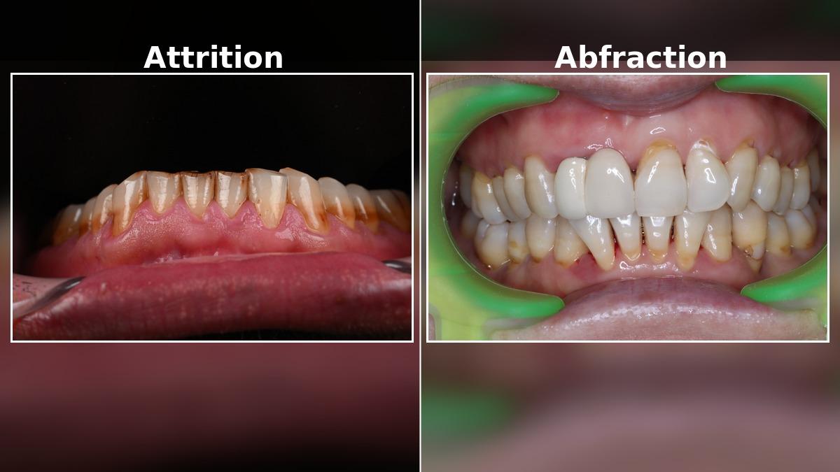 Common Dental Wear: Attrition vs Abfraction, Causes and Treatment?