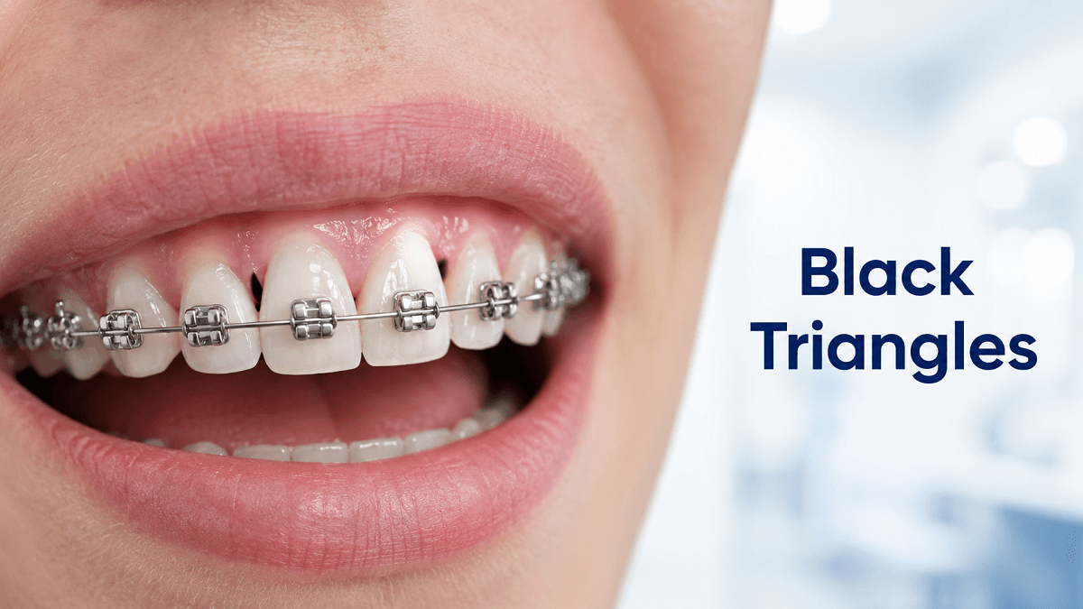 Black Triangles After Braces: Will They Go Away?