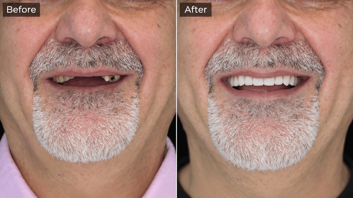 All-on-6 Full-mouth Restoration — Upper & Lower
