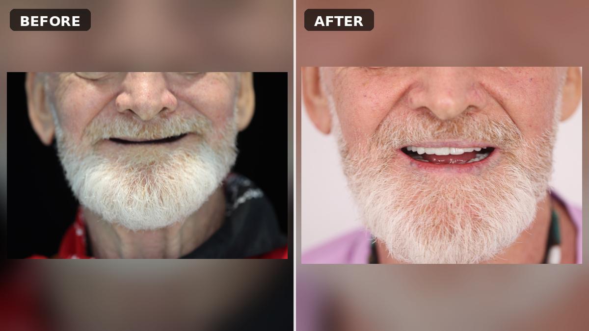 All-on-6 Dental Implants at Huangshan Dental: Same-Day Teeth Case for UK Patient