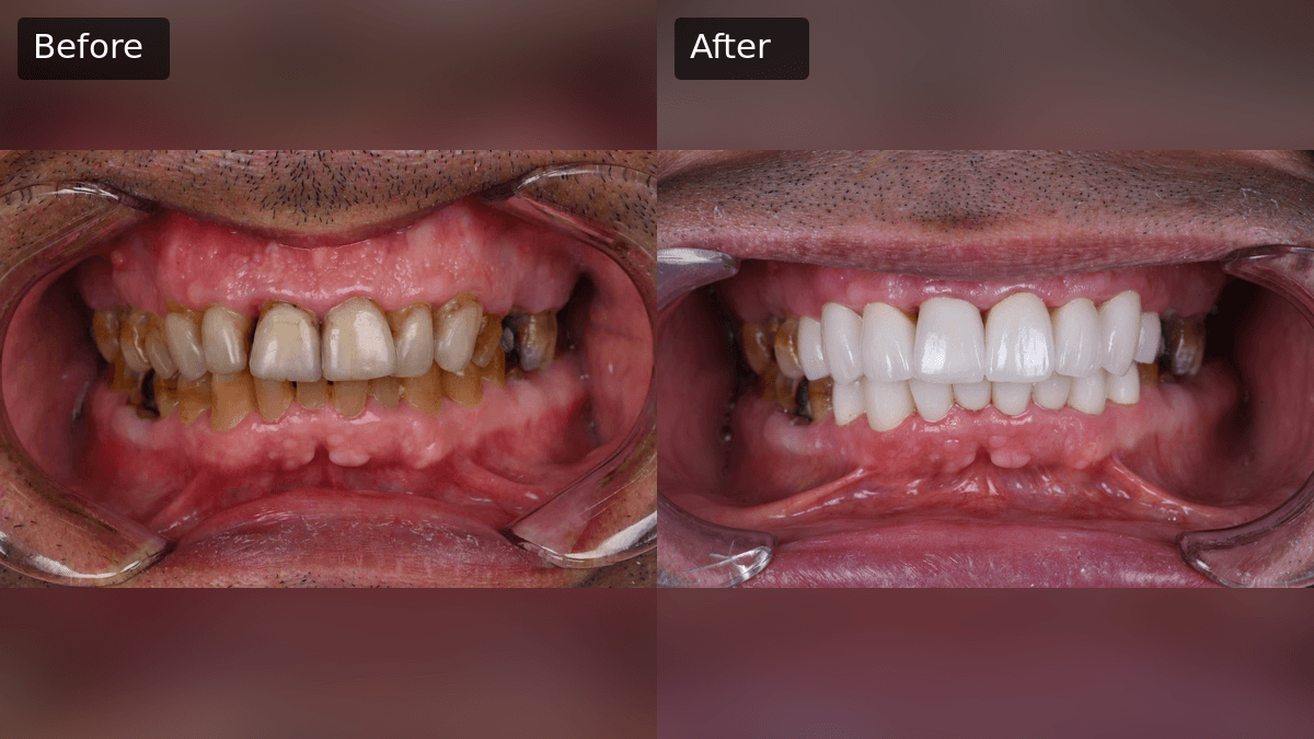 Bleeding Gums and Veneers Case: Smile Makeover at Huangshan Dental
