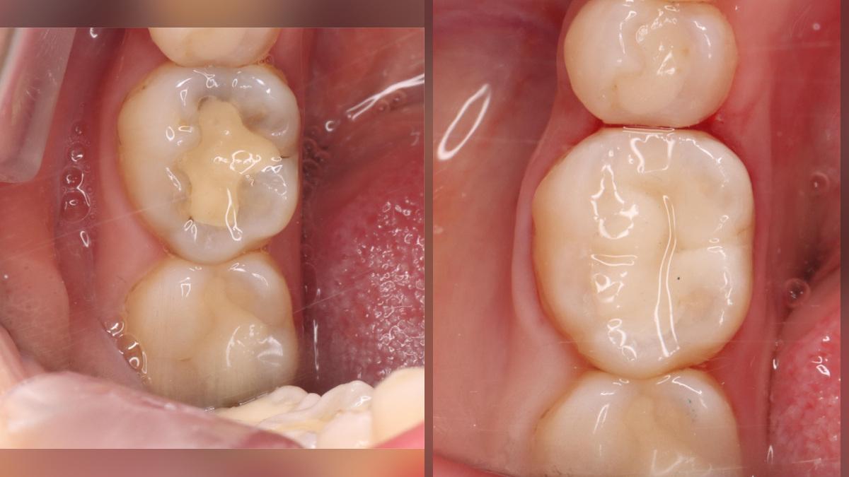 How to Prevent Secondary Caries Around Fillings and Crowns