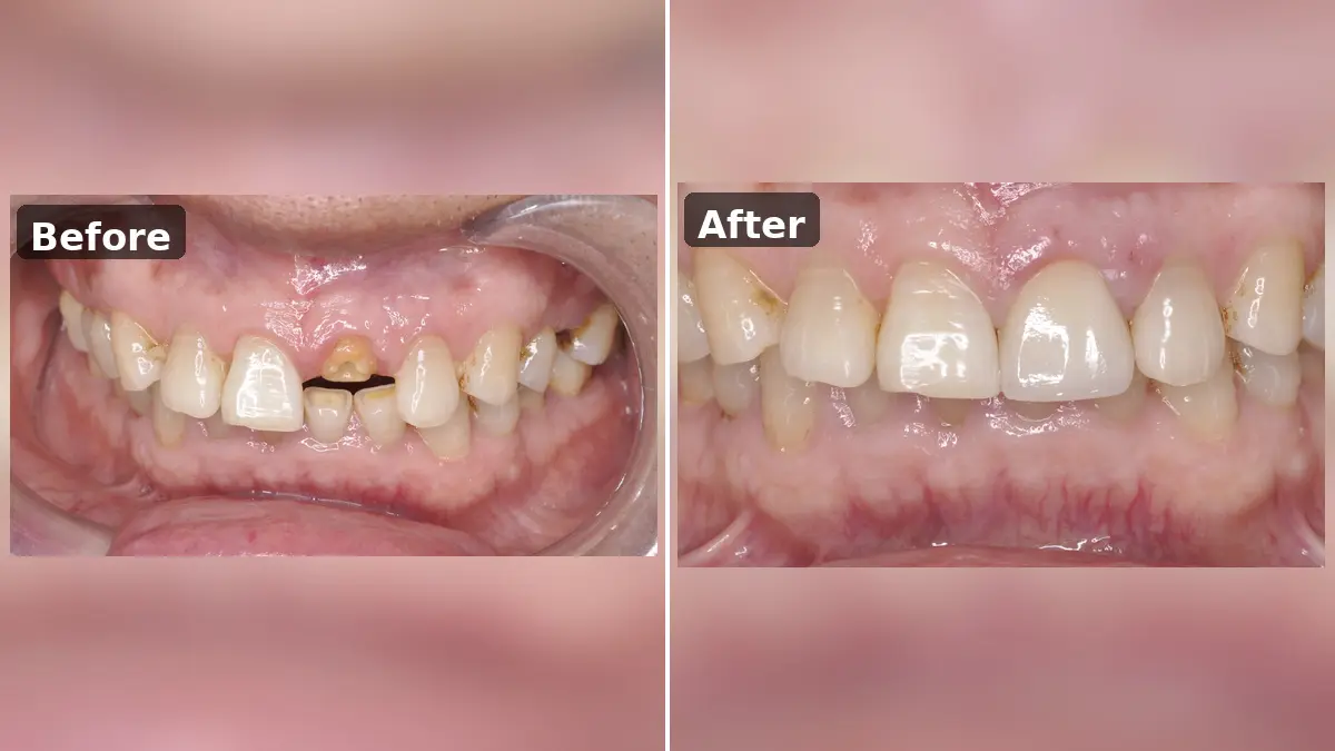 Broken Front Tooth Restored with Zirconia Crown Case