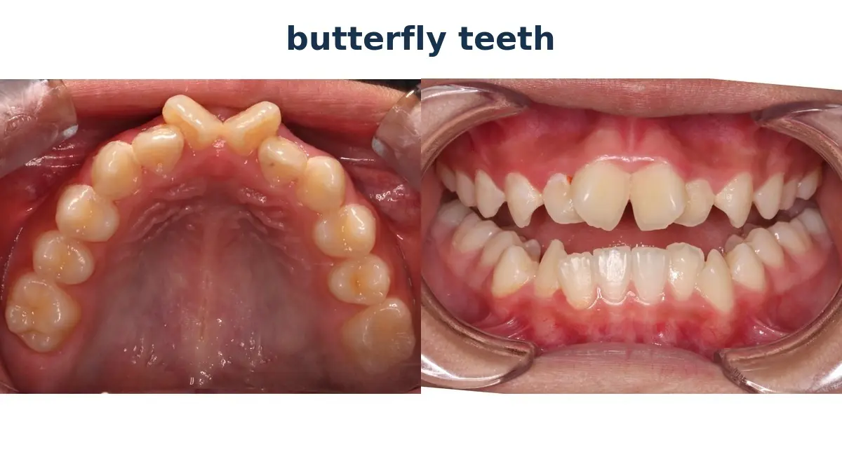 Butterfly Teeth: What They Are and How to Fix Them