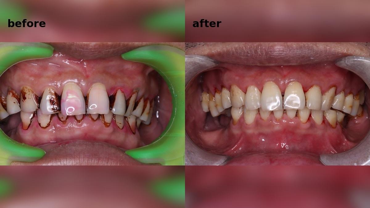 Smoking, Gum Disease and Missing Tooth Treatment Case