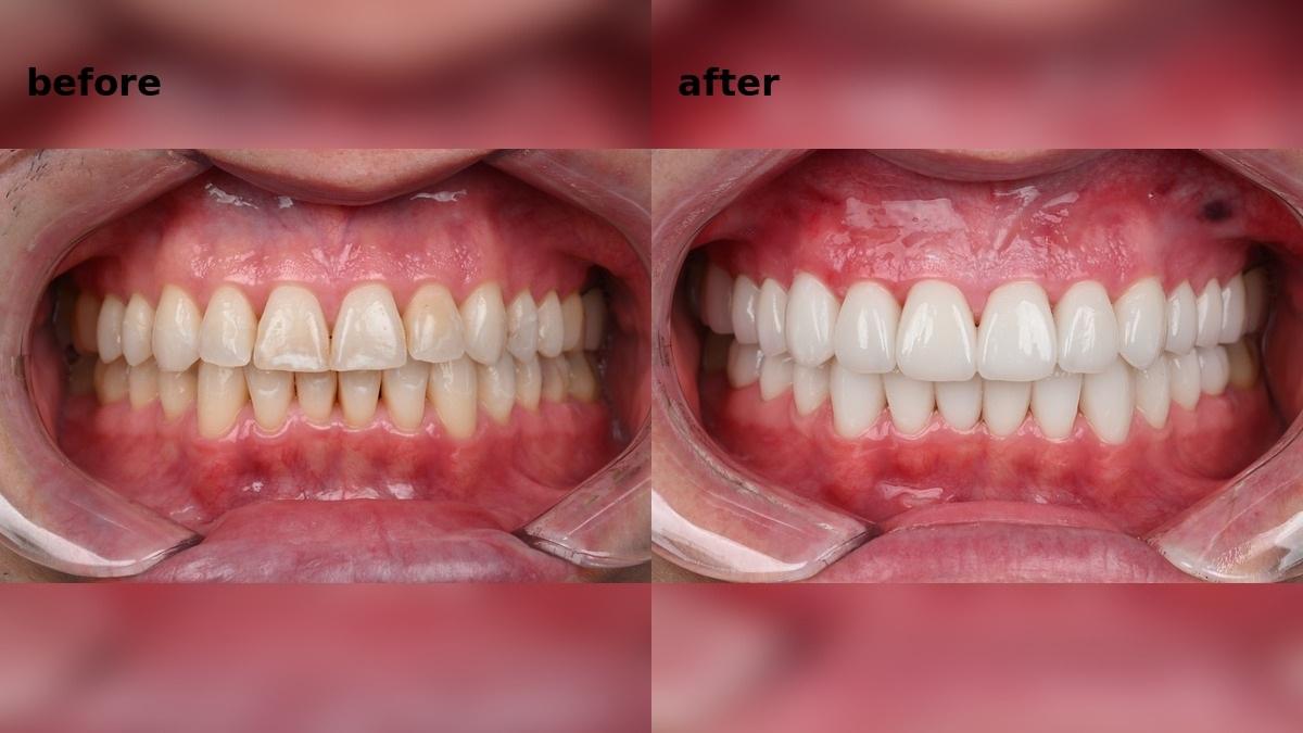 Zirconia Crowns and Veneers for Worn and Gapped Teeth