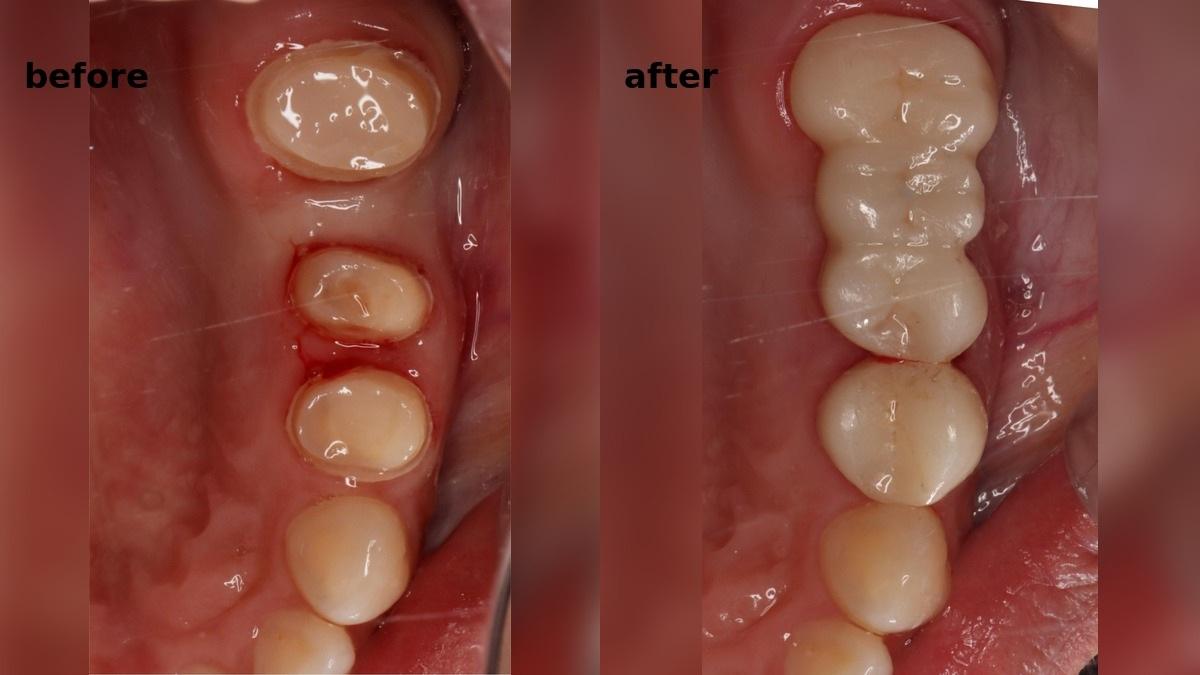 Zirconia Crown Restoration for Deep Tooth Decay Case