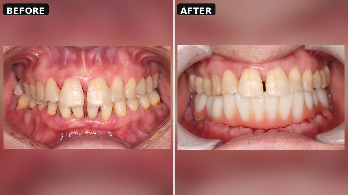 Lower-Jaw All-on-6 for Severe Periodontitis