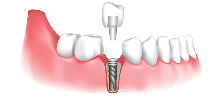 Dental Implant Procedures