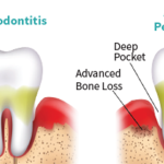 Gum Disease Information and FAQs
