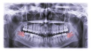 Patients really worry about 3rd-molar surgeries