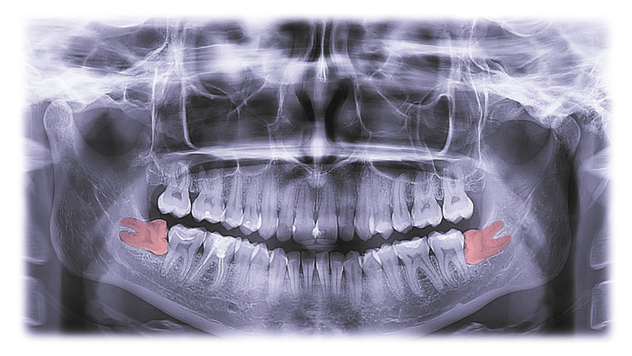 Patients really worry about 3rd-molar surgeries