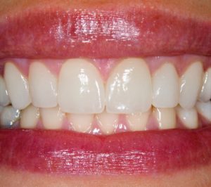 Dentists share more thoughts on the Miss Thailand viral veneer moment