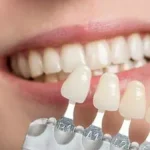 veneer
