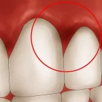 How to Get Rid of Gingivitis Overnight?