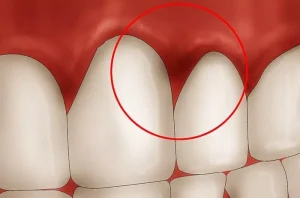 How to Get Rid of Gingivitis Overnight?