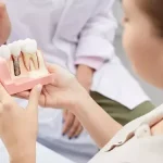 local dental implants