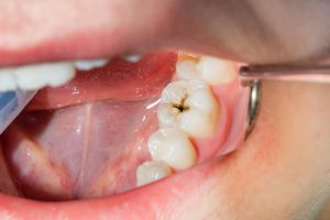 SDF may remineralize teeth