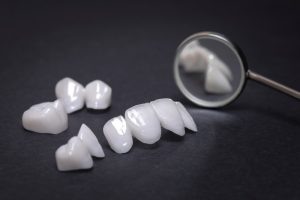 When veneers fail: Lessons from a viral moment