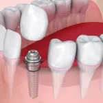 dental implant cost NYC