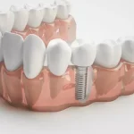 permanent teeth fixing