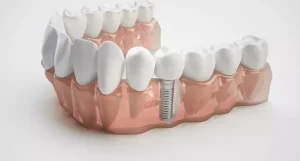 permanent teeth fixing