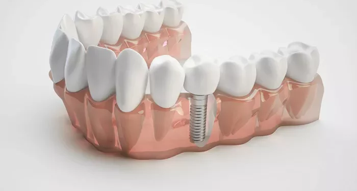 permanent teeth fixing