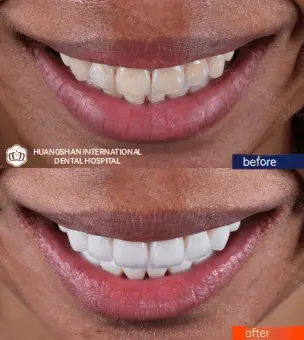 E-MAX Veneers Before & After