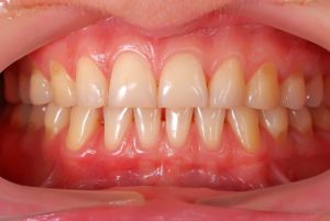 healthy tooth