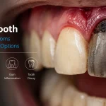 dead tooth