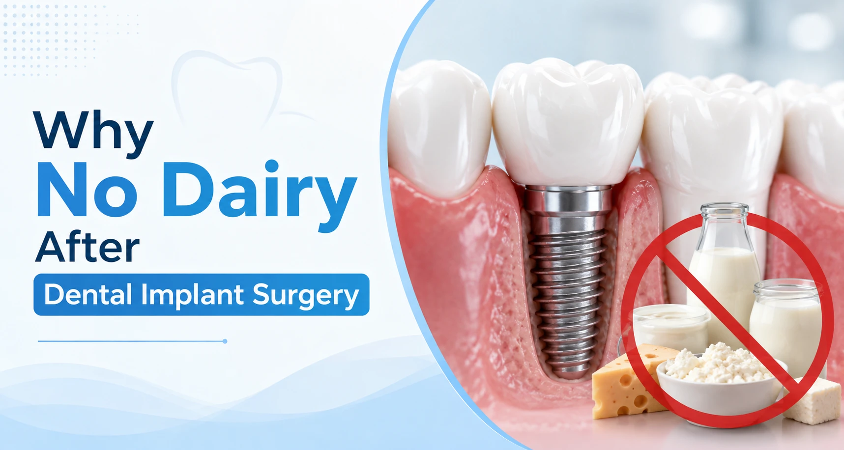 why no dairy after dental implant​​