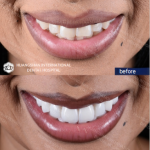 Veneer Before and After
