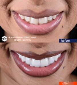 Veneer Before and After