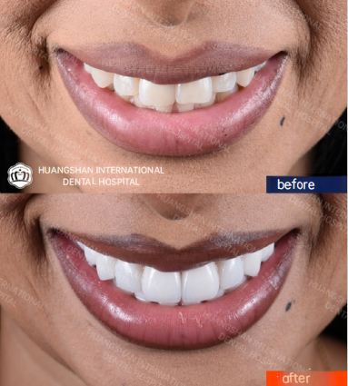 Veneer Before and After