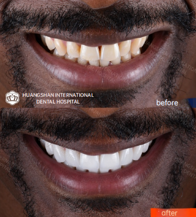 veneer before and after