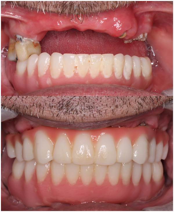 dental implants in China