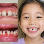 kids' big front teeth