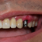 swollen gums after dental implants